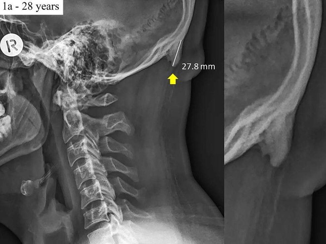 These bony projections arise from the parts where the tendon attaches to a bone